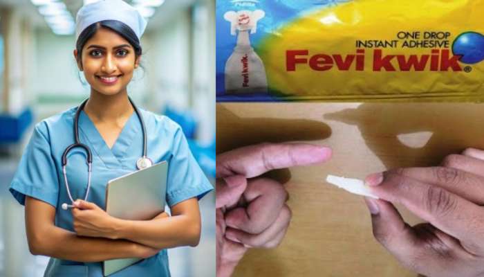 Nurse Uses Fevikwik: వామ్మో.. పెషెంట్‌ గాయానికి కుట్లకు బదులు.. ఫెవీక్విక్ పూసిన నర్సు.. ఎక్కడంటే..?