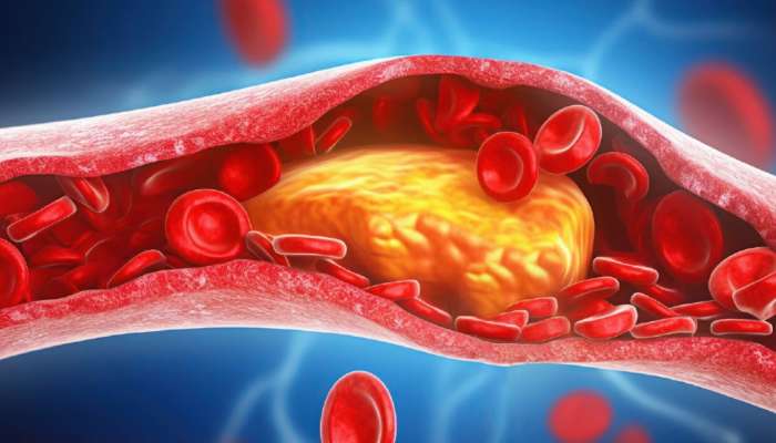 Bad Cholesterol: ఈ ఆయుర్వేద చిట్కాలు పాటిస్తే.. మొండి చెడు కొలెస్ట్రాల్‌ సైతం కరిగిపోవడం ఖాయం..!!