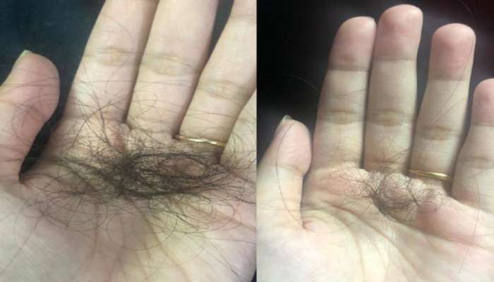 Hair Fall: మీరు ప్రతిరోజు తినే ఈ 5 ఆహారాలు.. జుట్టు విపరీతంగా రాలడానికి అసలు కారణాలు..