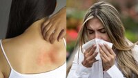 World allergy foundation: భారత్ లోనే తొలిసారి అలెర్జీలపై కీలక నివేదిక.. వెలుగులోకి 