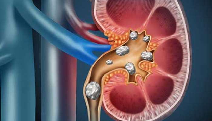 Kidney Stones: కిడ్నీలో రాళ్ల సమస్య బాధిస్తోందా, ఈ చిట్కాలతో మటుమాయం