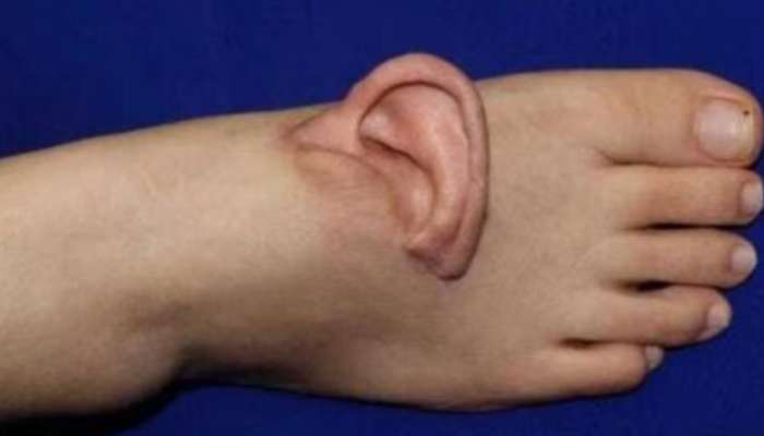 Shocking: మహిళ చేవిని కాళుకు అతికించిన షాకింగ్‌ ఘటన.. 5 నెలలు అలాగే..! ఎందుకో తెలుసా?