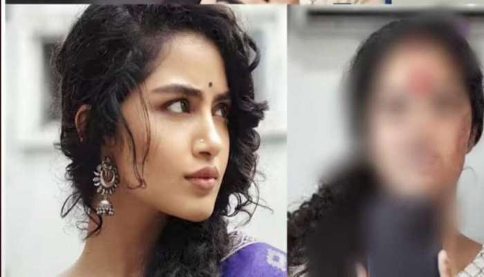 Anupama Parameswaran: ముఖం నిండా గాయాలతో అనుపమ.. టెన్షన్ లో ఫ్యాన్స్..!