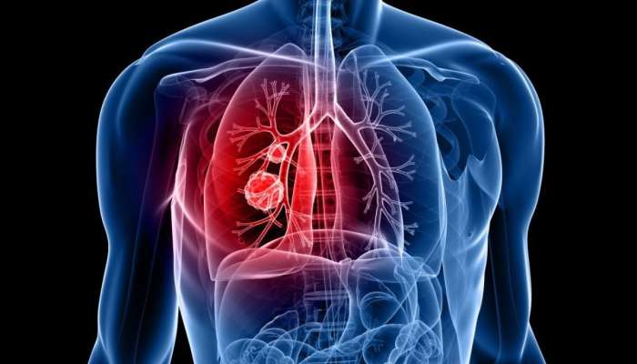 Lung Cancer Reasons: సిగరెట్ స్మోకింగ్, కాలుష్యం మాత్రమే కాదు ఈ 5 కూడా లంగ్ కేన్సర్‌కు కారణాలే