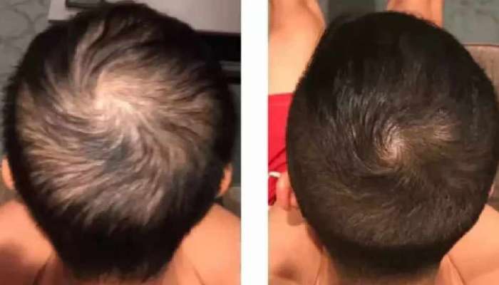Hair on Bald Head: బట్టతల ప్యాచ్ పైన కూడా 18 రోజుల్లో వెంట్రుకలు రావాలి అంటే.. ఈ ఒక్క పని చేయండి..!