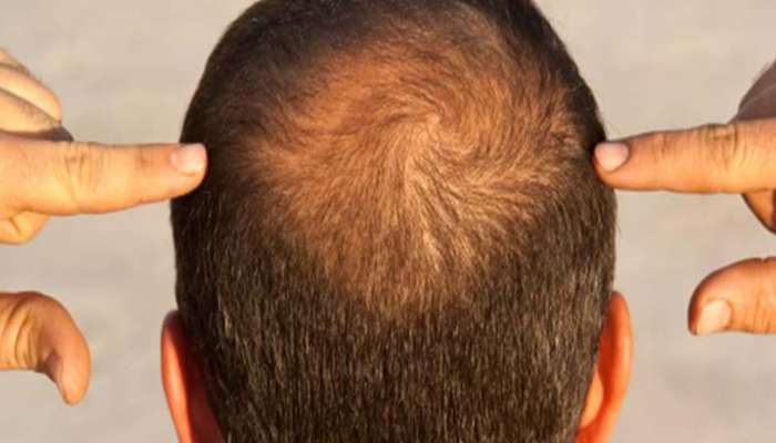 Hair Fall Remedies: ఈ హోమ్ రెమిడీ యూజ్ చేస్తే వృద్ధాప్యంలో కూడా నో హెయిర్ ఫాల్