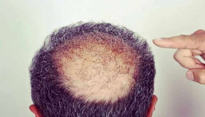Hair Growth: బట్టతలపై కూడా జుట్టుని తెచ్చే స్ప్రే..కొత్త వెంట్రుకలను తెచ్చుకోండి ఇలా..