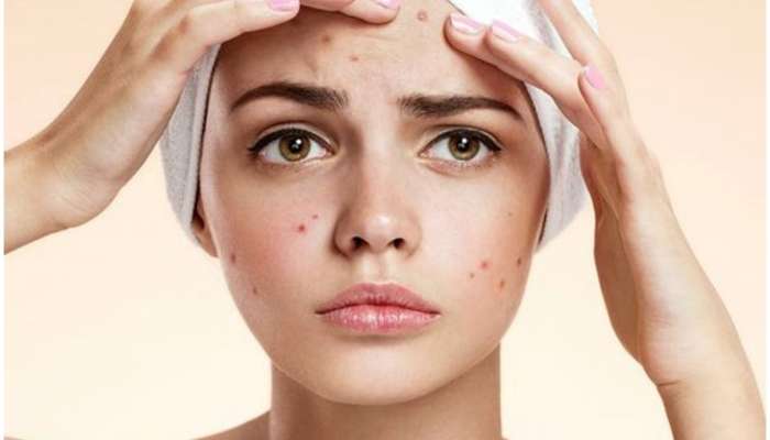 Monsoon Skin Care: వర్షాకాలంలో మీ చర్మం జడ్డుగా మారుతోందా, ఈ టిప్స్ ట్రై చేయండి